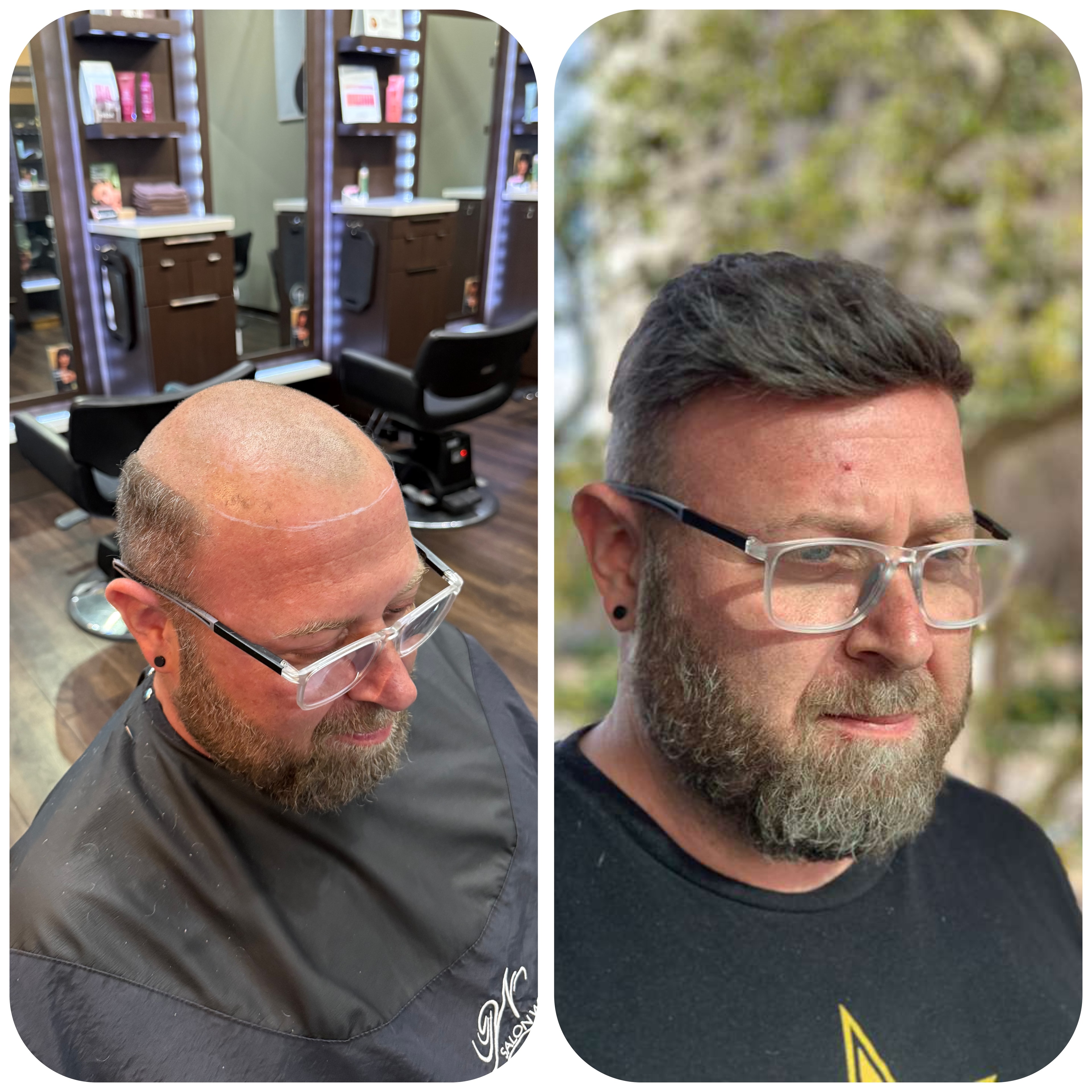 Before & after — Hairskeen Men’s Hair System